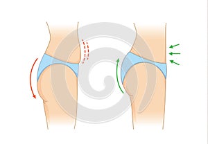 Reduce fat at buttock and abdomen for beauty shape.