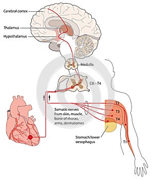 Referred pain signals heart and chest