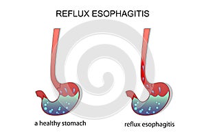 Reflux esophagitis stomach.