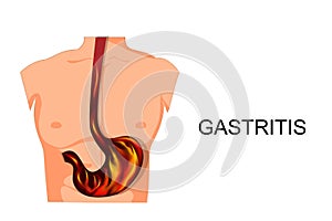 Reflux esophagitis stomach. photo