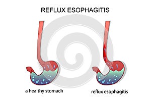 Reflux esophagitis stomach. photo