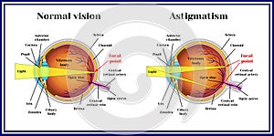 Refractive errors eyeball. Astigmatism. Medicine. photo