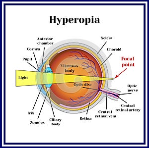 Refractive errors eyeball. Hyperopia. Medicine