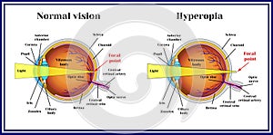 Refractive errors eyeball. Hyperopia. Medicine photo