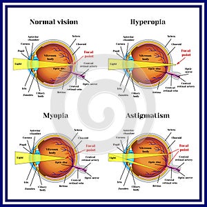 Refractive errors eyeball: hyperopia, myopia, astigmatism.