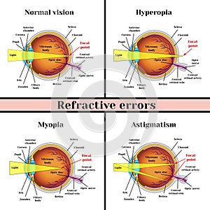 Refractive errors eyeball: hyperopia, myopia, astigmatism. photo