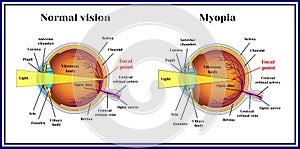 Refractive errors eyeball. Myopia. Medicine. photo