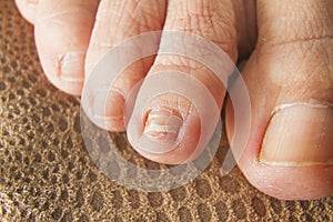 Regrown Foot Nail