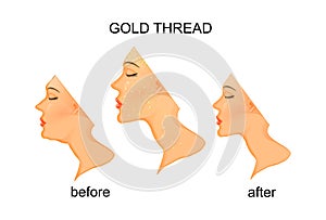 Rejuvenation of the face and neck with gold thread