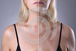 Rejuvenation woman`s skin, before after anti aging concept, wrinkle treatment, facelift and plastic surgery