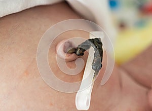 The remains of the umbilical cord in a baby after birth. Healing of the umbilical wound and umbilical ring, close-up