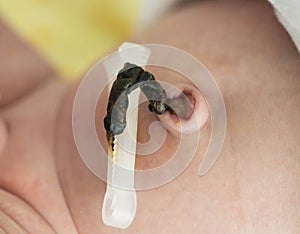 Remains of the umbilical cord with a clip in a newborn. Treatment and care of the navel in an infant. Close-up