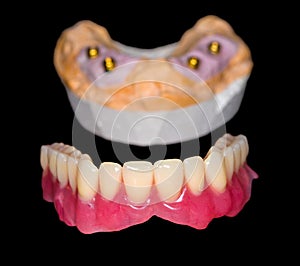 Removable denture