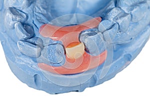 Removable incisor prosthesis