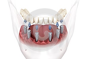 Removable mandibular prosthesis all on 6 system supported by implants. Medically accurate 3D illustration of human teeth and