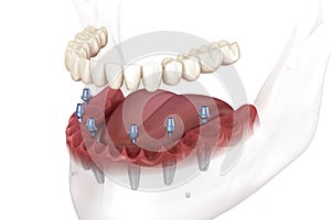 Removable mandibular prosthesis all on 6 system supported by implants. Medically accurate 3D illustration of human teeth and