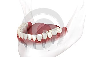 Removable mandibular prosthesis all on 6 system supported by implants. Medically accurate 3D illustration of human teeth and