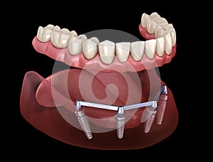 Removable Mandibular prosthesis with gum All on 4 system supported by implants. Medically accurate 3D illustration of human teeth photo