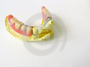 Removable partial denture in dental clinic