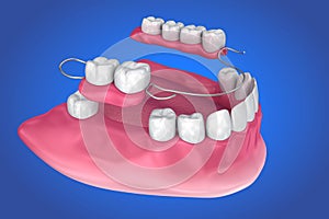 Removable partial denture. Medically accurate