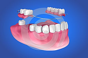 Removable partial denture. Medically accurate