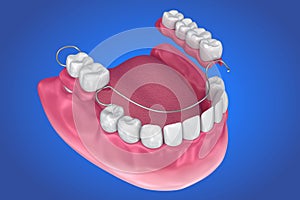 Removable partial denture. Medically accurate