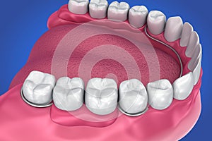 Removable partial denture. Medically accurate