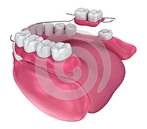 Removable partial denture. Medically accurate