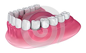 Removable partial denture. Medically accurate