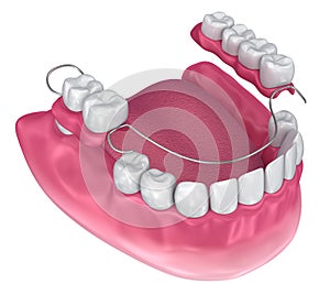 Removable partial denture. Medically accurate photo