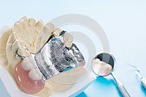 Removable partial denture RPD.