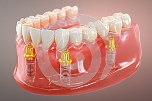 Removable Partial Denture Supported by Dental Implants