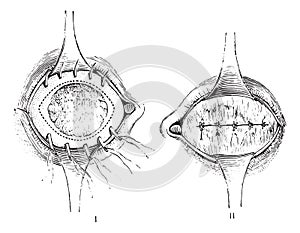Removal of the anterior segment of the eye with total staphyloma