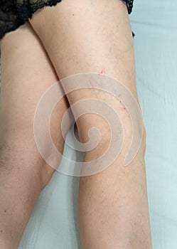 removal of blood vessels by laser vessel body blood, problem skin medicine therapy, pathology. close dermis, remove