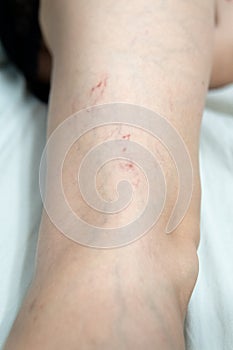 removal of blood vessels by laser vessel surgery, leg problem pressure health beauty, veins Help risk enlarged, tortuous