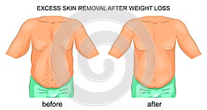 Removal of excess skin after weight loss