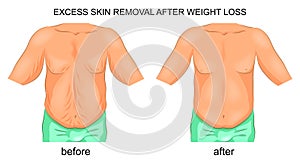 Removal of excess skin after weight loss photo