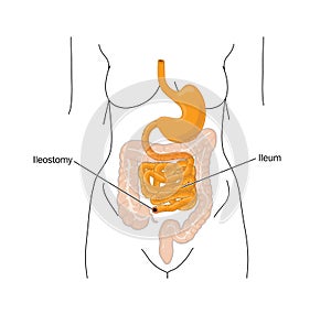 Removal of the large bowel and ileostomy