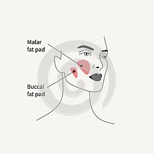 Removal of malar fat pad and buccal fat pad