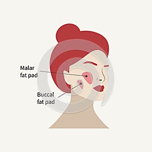Removal of malar fat pad and buccal fat pad