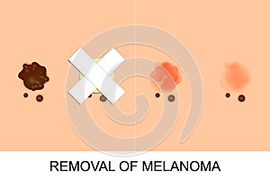 Removal of melanoma