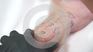 Removal of an old tattoo with a laser in an aesthetic medicine clinic.