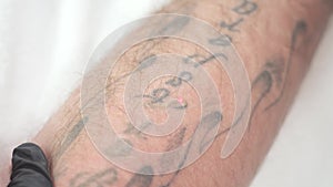 Removal of an old tattoo with a laser in an aesthetic medicine clinic.