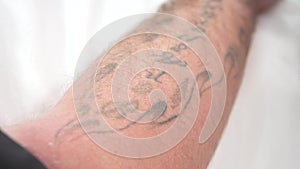 Removal of an old tattoo with a laser in an aesthetic medicine clinic.