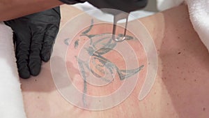 Removal of an old tattoo with a laser in an aesthetic medicine clinic.