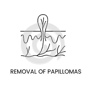 Removal of papillomas line icon in vector, illustration of papilloma in skin layers