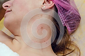 Removal of papillomas on neck in a beauty salon