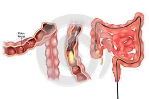 Removal polyps of the Colon. Colonoscopy