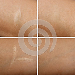 Eliminación de cicatrices sobre el piel 