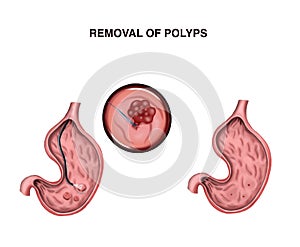 Removal of stomach polyps